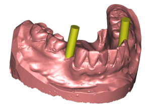 3-D Implantatplanung