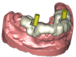 Operationsschablone - angefertigt  nach virtueller Implantation 